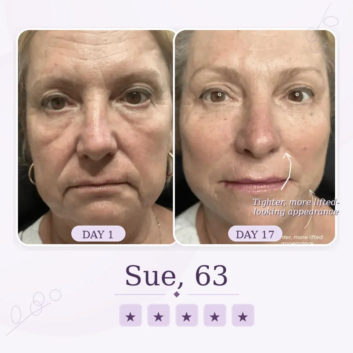 Sculptics Mask – Double Chin Lifting Mask