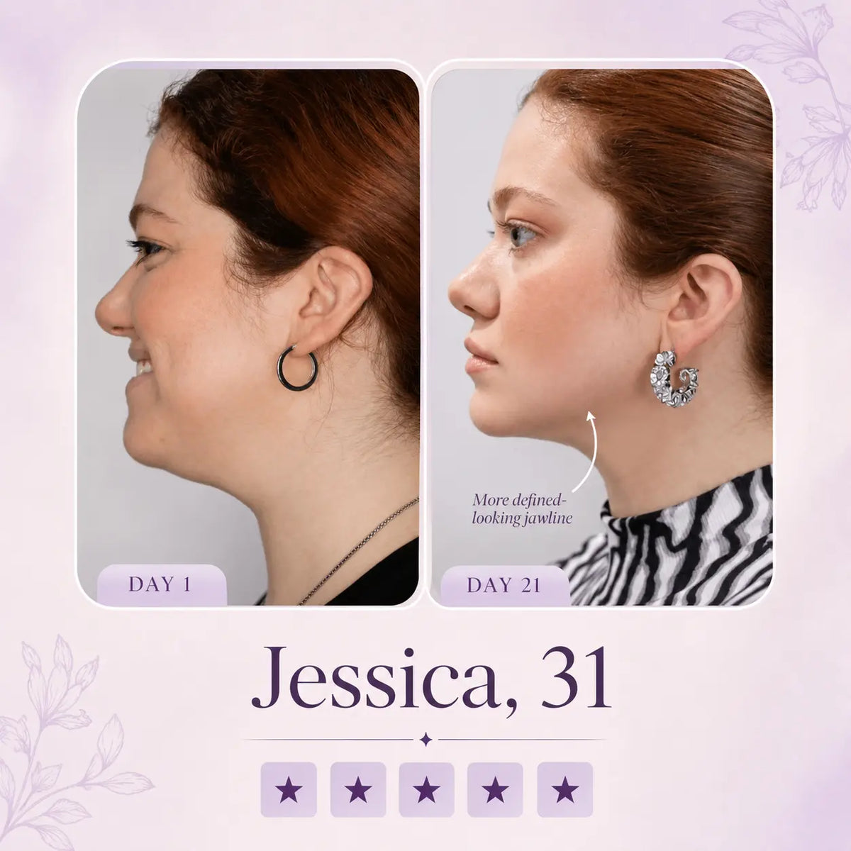 Sculptics Mask – Double Chin Lifting Mask